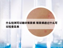 什么检测可以确诊银屑病 银屑病通过什么可以检查出来