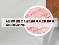 头部银屑病擦了卡泊三醇很痒 头皮银屑病用卡泊三醇搽剂发红