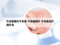 牛皮廨图片牛皮廨 牛皮廨图片 牛皮廨治疗图片皮