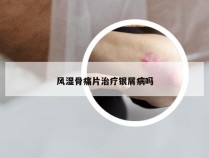 风湿骨痛片治疗银屑病吗