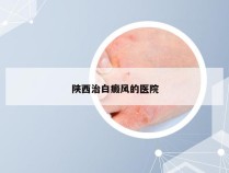 陕西治白癜风的医院