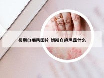 初期白癞风图片 初期白癞风是什么