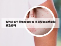 如何治关节型银屑病有效 关节型银屑病能彻底治愈吗