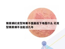 银屑病红皮型如果不医最后下场是什么 红皮型银屑病不治能活几年