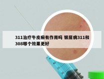 311治疗牛皮癣有作用吗 银屑病311和308哪个效果更好
