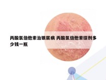 丙酸氯倍他索治银屑病 丙酸氯倍他索搽剂多少钱一瓶