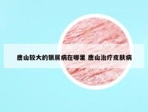 唐山较大的银屑病在哪里 唐山治疗皮肤病