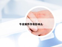牛皮癣怀孕有影响么