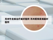 苏州牛皮癣治疗最好医院 苏州看银屑病最好医院