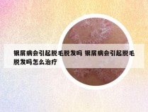 银屑病会引起脱毛脱发吗 银屑病会引起脱毛脱发吗怎么治疗