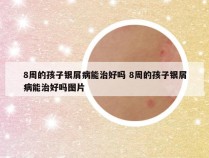 8周的孩子银屑病能治好吗 8周的孩子银屑病能治好吗图片