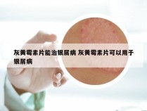 灰黄霉素片能治银屑病 灰黄霉素片可以用于银屑病