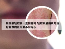 银屑病轻症会一直很轻吗 轻症银屑病及时治疗复发的几率会不会缩小