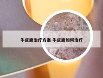 牛皮廨治疗方案 牛皮廨如何治疗