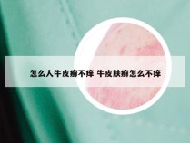 怎么人牛皮癣不痒 牛皮肤癣怎么不痒