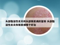 头部脂溢性皮炎和头部银屑病的鉴别 头部脂溢性皮炎和银屑病哪个好治
