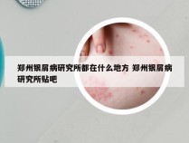 郑州银屑病研究所都在什么地方 郑州银屑病研究所贴吧