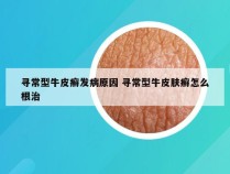 寻常型牛皮癣发病原因 寻常型牛皮肤癣怎么根治