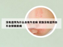 没有遗传为什么会有牛皮癣 家族没有遗传会不会得银屑病