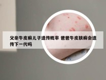 父亲牛皮癣儿子遗传概率 爸爸牛皮肤癣会遗传下一代吗