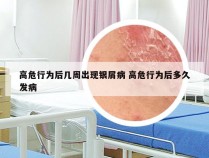 高危行为后几周出现银屑病 高危行为后多久发病