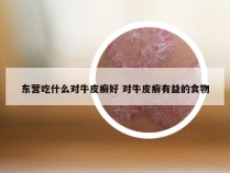 东营吃什么对牛皮癣好 对牛皮癣有益的食物