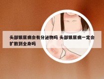 头部银屑病会有分泌物吗 头部银屑病一定会扩散到全身吗