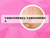 牛皮癣长时间熬夜好么 牛皮癣长时间熬夜好么
