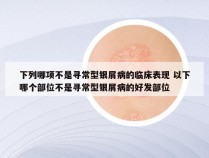 下列哪项不是寻常型银屑病的临床表现 以下哪个部位不是寻常型银屑病的好发部位