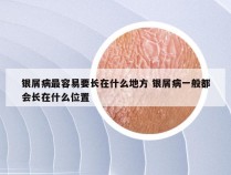 银屑病最容易要长在什么地方 银屑病一般都会长在什么位置