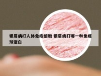 银屑病打人体免疫细胞 银屑病打哪一种免疫球蛋白