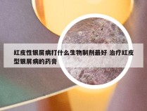 红皮性银屑病打什么生物制剂最好 治疗红皮型银屑病的药膏