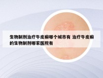生物制剂治疗牛皮癣哪个城市有 治疗牛皮癣的生物制剂哪家医院有