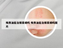 梅焦油能治银屑病吗 梅焦油能治银屑病吗图片