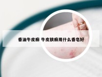 香油牛皮癣 牛皮肤癣用什么香皂好