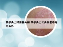 孩子头上好像有头癣 孩子头上长头癣老不好怎么办