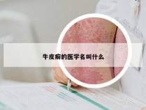 牛皮癣的医学名叫什么