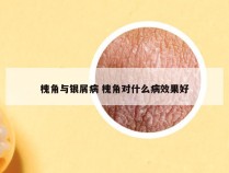 槐角与银屑病 槐角对什么病效果好