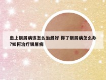 患上银屑病该怎么治最好 得了银屑病怎么办?如何治疗银屑病