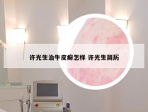 许光生治牛皮癣怎样 许光生简历