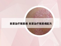 青黛治疗银屑病 青黛治疗银屑病配方