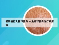 银屑病打人体球蛋白 人免疫球蛋白治疗银屑病