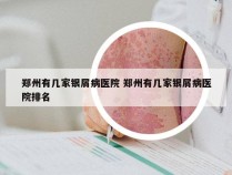郑州有几家银屑病医院 郑州有几家银屑病医院排名