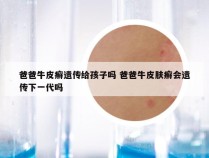爸爸牛皮癣遗传给孩子吗 爸爸牛皮肤癣会遗传下一代吗