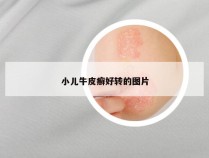 小儿牛皮癣好转的图片
