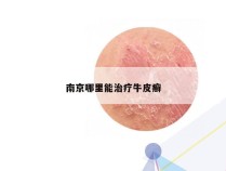 南京哪里能治疗牛皮癣