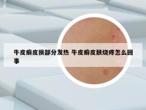 牛皮癣皮损部分发热 牛皮癣皮肤烧疼怎么回事