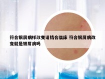 符合银屑病样改变请结合临床 符合银屑病改变就是银屑病吗