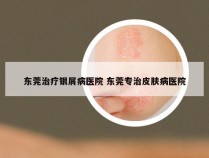 东莞治疗银屑病医院 东莞专治皮肤病医院