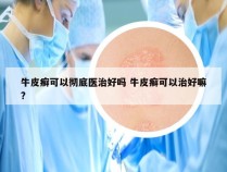 牛皮癣可以彻底医治好吗 牛皮癣可以治好嘛?